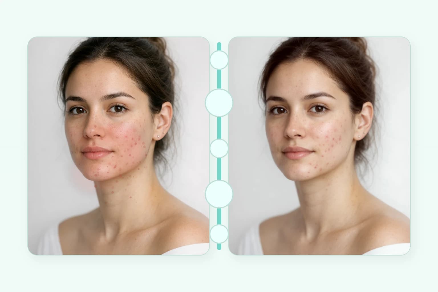 Acne Clarifying Facial at NPMD