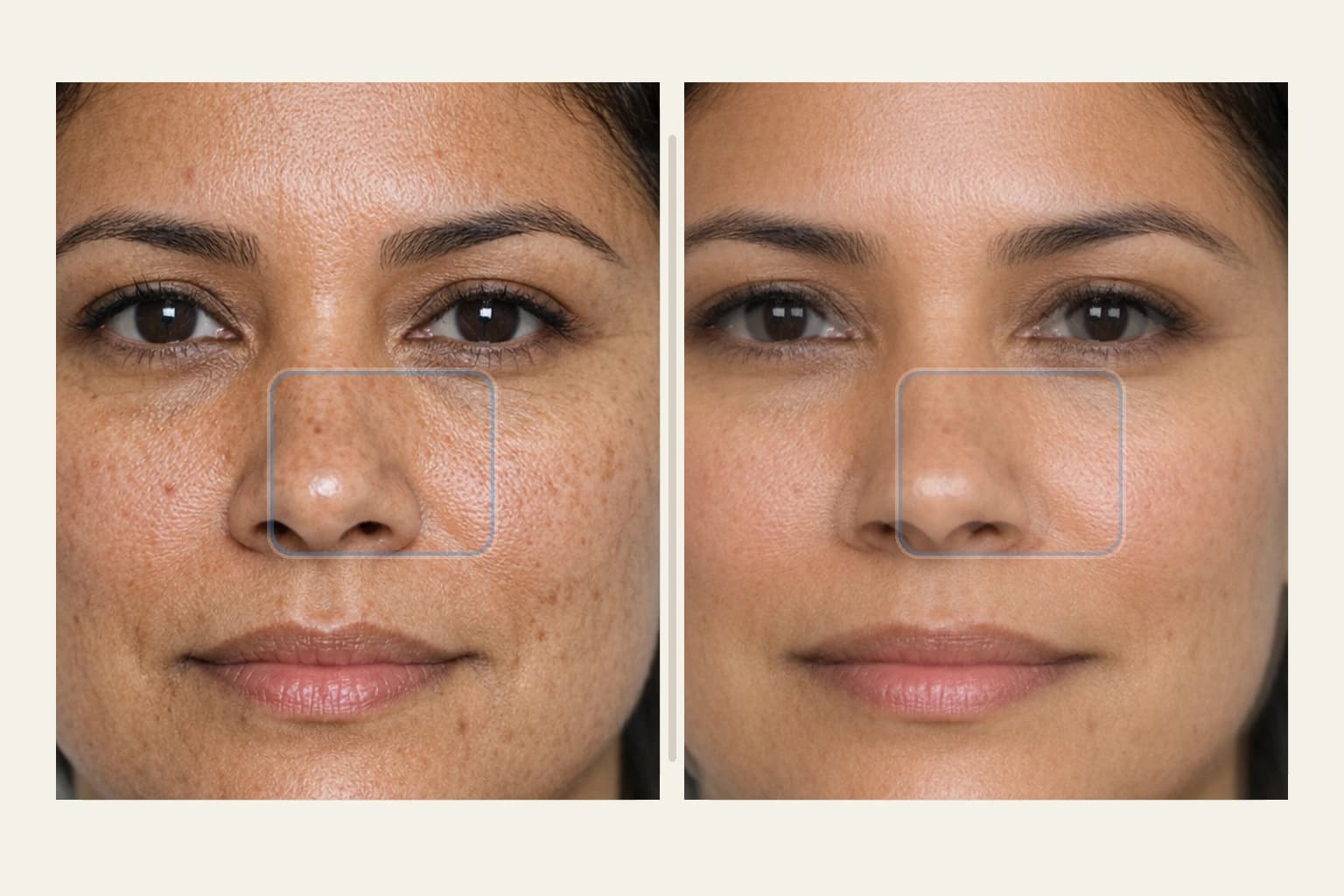 CO2 Laser Spot Treatment at NPMD