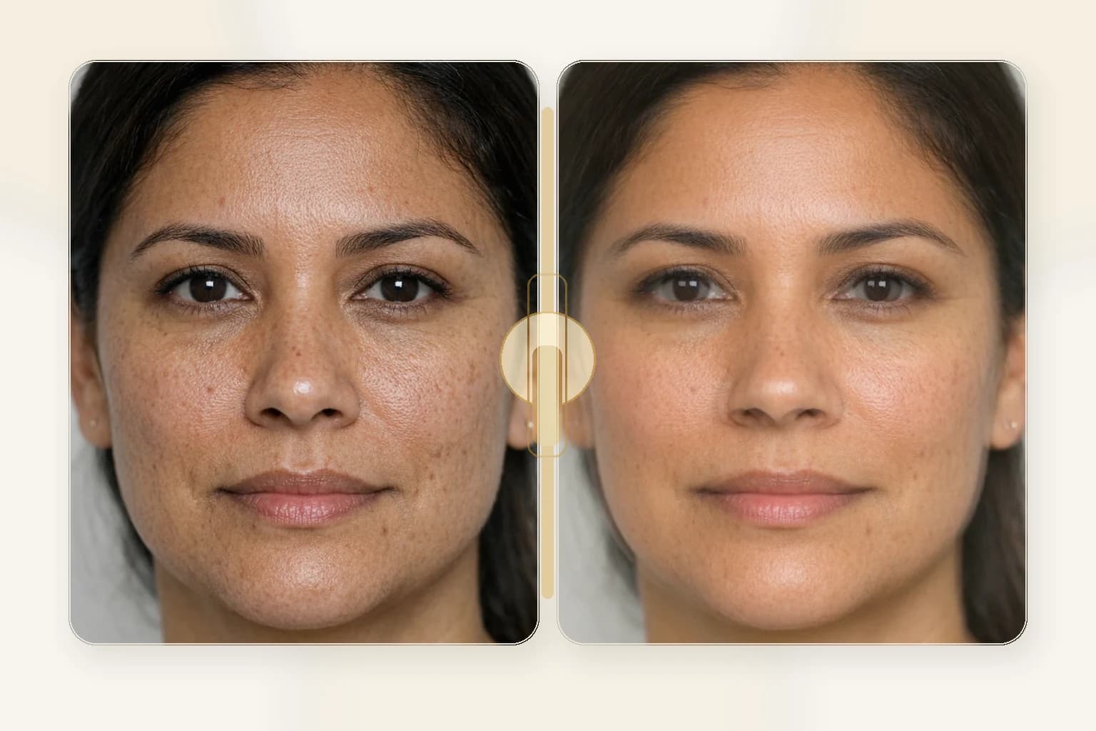Microneedling with PRP at NPMD