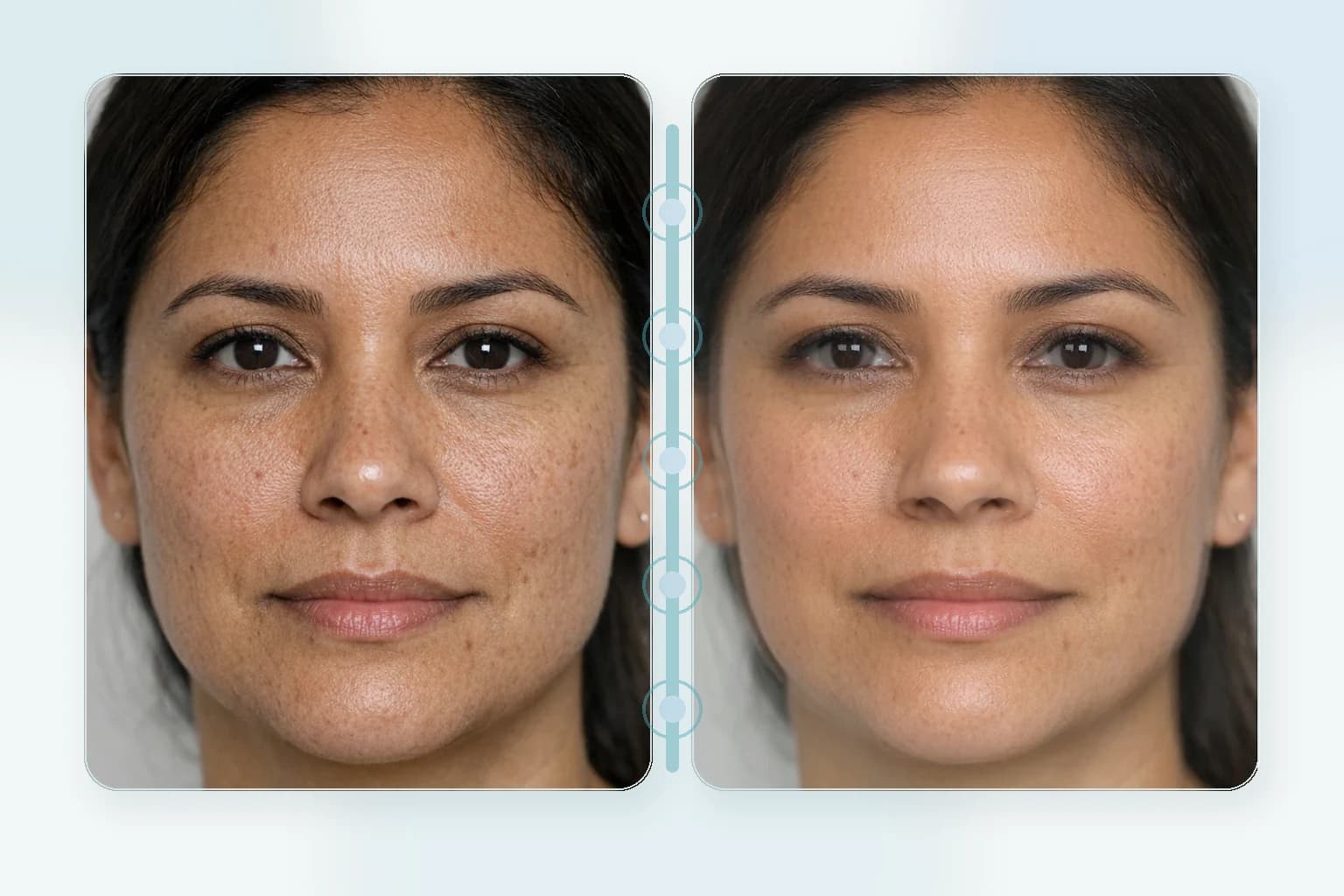 RF Microneedling at NPMD
