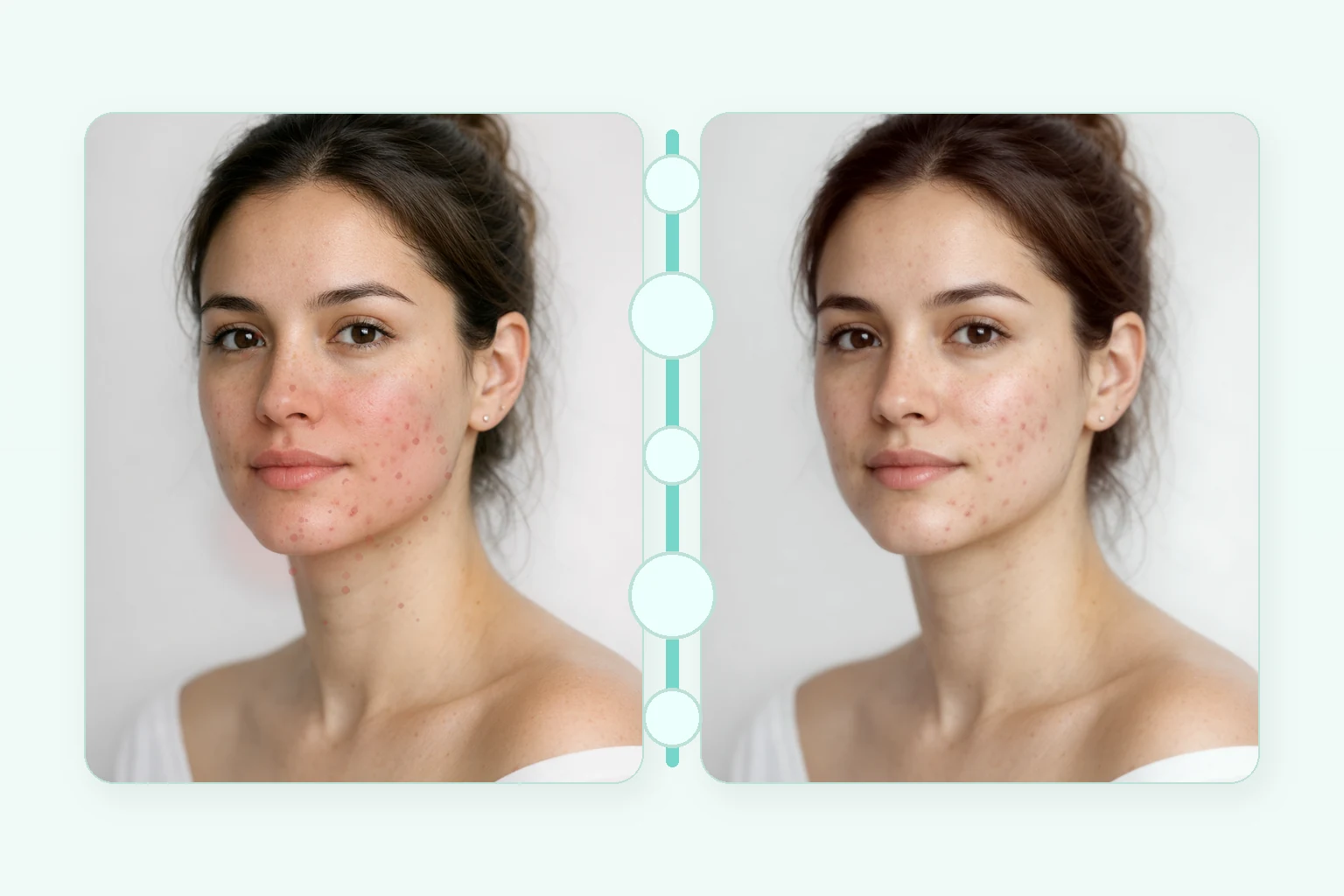 Illustrative before and after comparison for an Acne Clarifying Facial showing reduced congestion and calmer redness