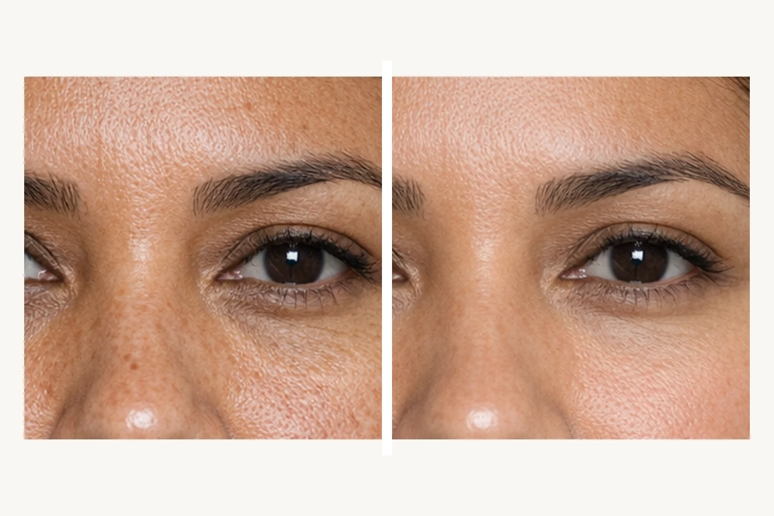 Illustrative eye-area detail comparison for CO2 laser rejuvenation around the eyes