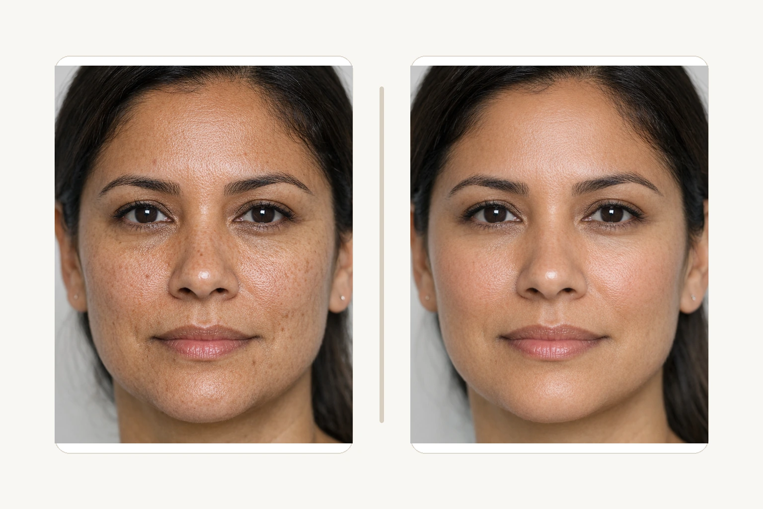 Illustrative full-face texture review comparison for CO2 laser resurfacing