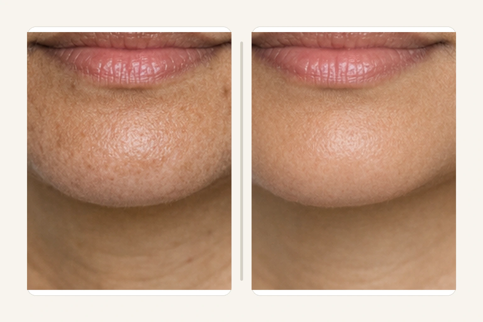 Illustrative neck detail comparison for CO2 laser resurfacing of fine lines and crepey texture
