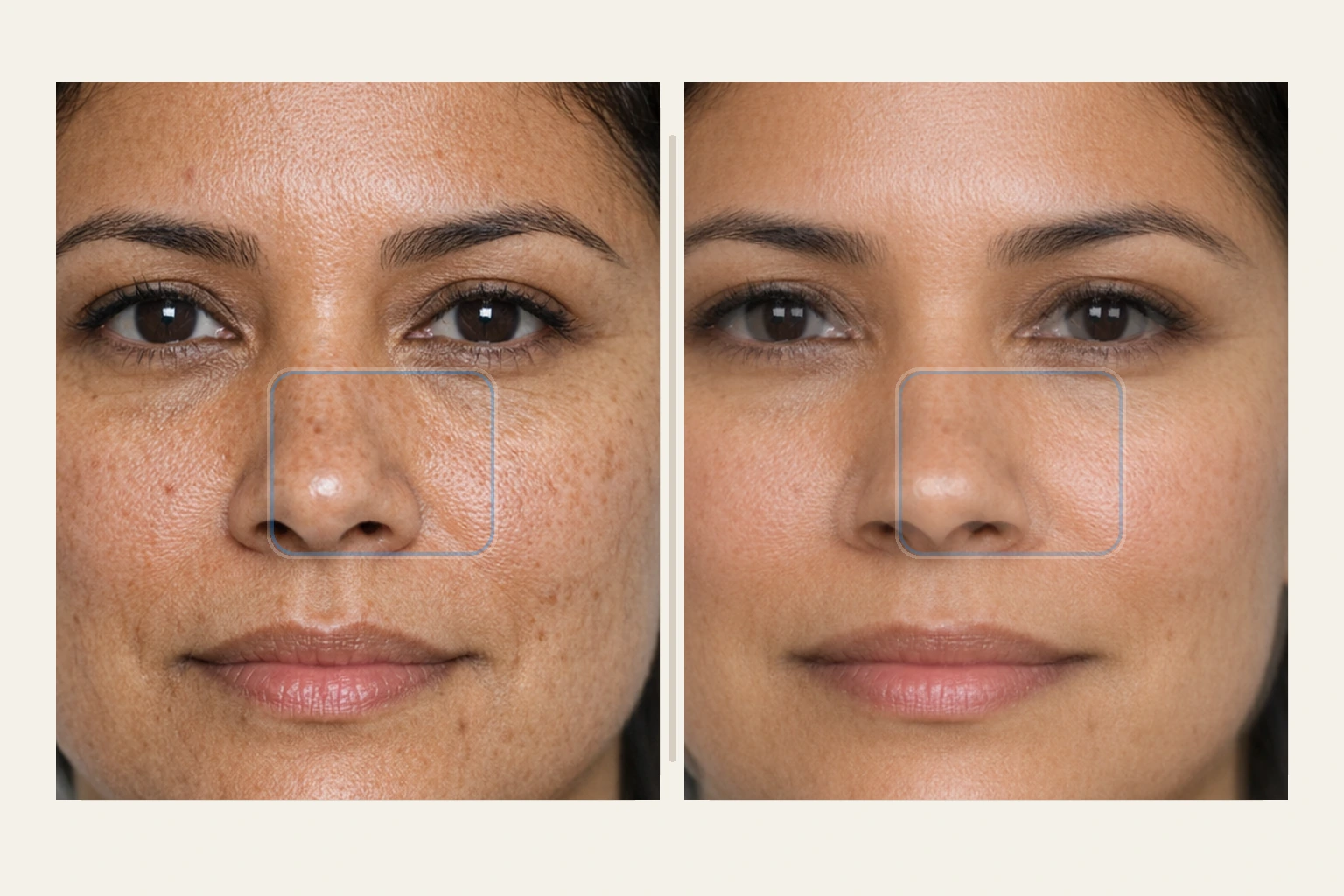 Illustrative before and after targeted resurfacing comparison for CO2 laser spot treatment