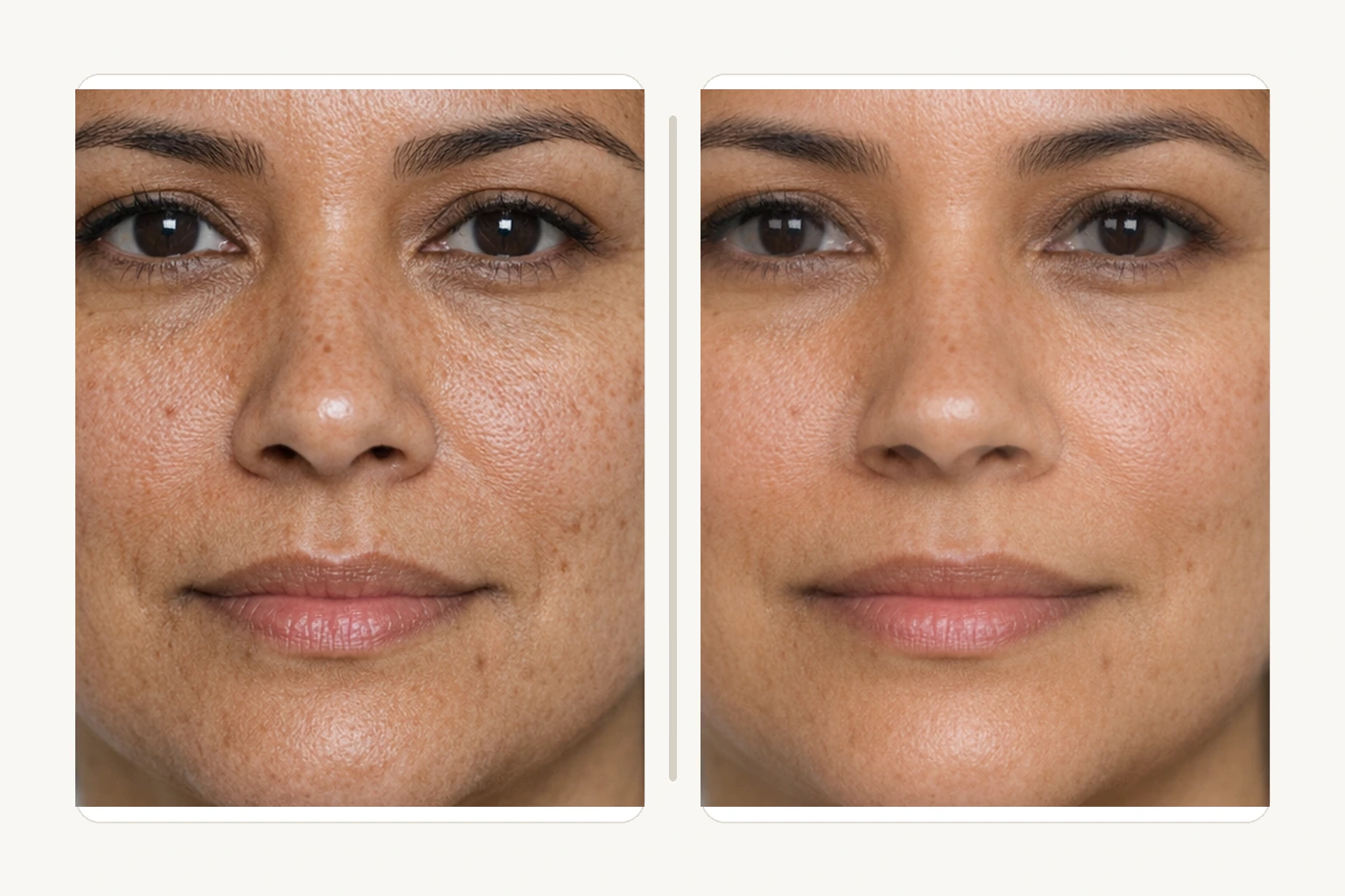 Illustrative texture and pore detail comparison after microneedling facial