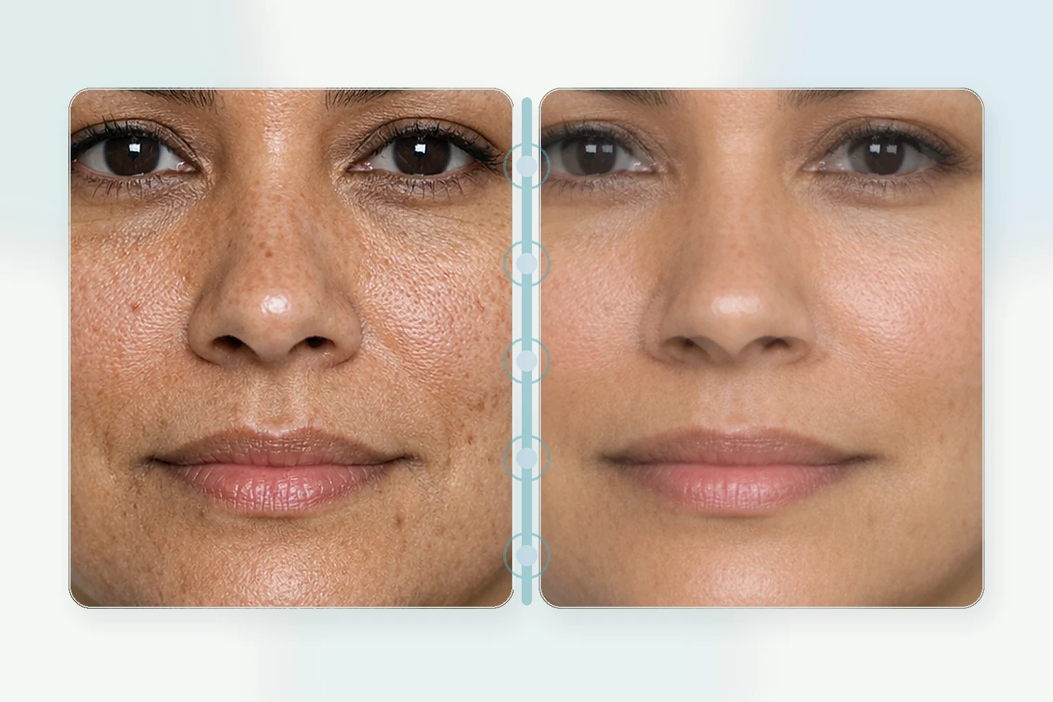Illustrative before and after comparison for RF microneedling improving acne scar texture