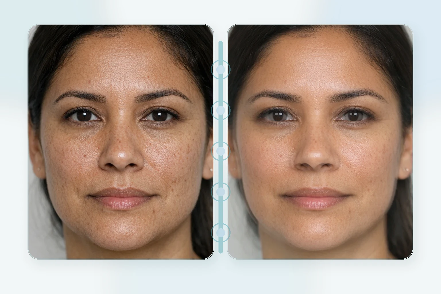 Illustrative before and after comparison for RF microneedling showing subtle skin tightening and texture refinement